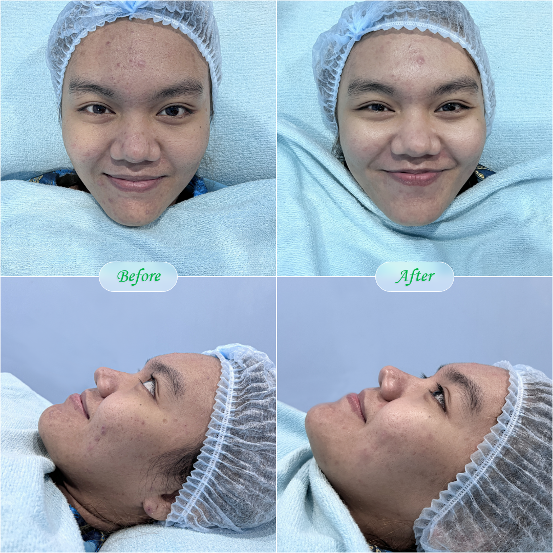 Before After